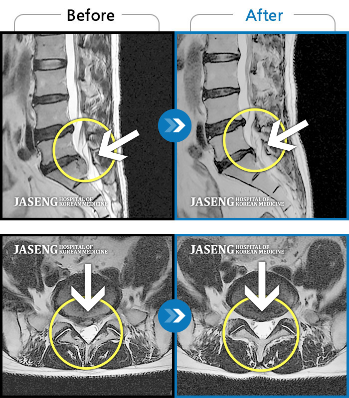 자생한방병원 치료사례 MRI로 보는 치료결과-오른쪽 허리 통증, 허리를 숙일 때 다리 당김 증상