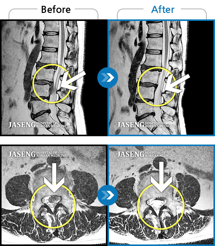 자생한방병원 치료사례 MRI로 보는 치료결과-허리디스크로 인한 보행시 통증 및 다리 근력 저하 