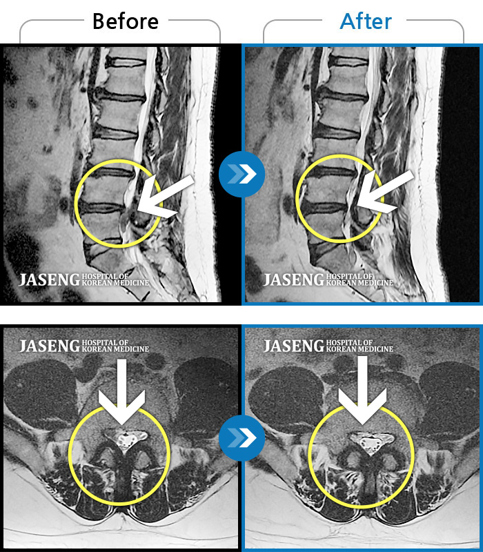 자생한방병원 치료사례 MRI로 보는 치료결과-하요추부, 우측 둔부 통증 및 우측 하지 비증