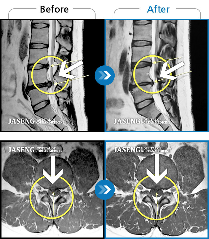 자생한방병원 치료사례 MRI로 보는 치료결과-요통 및 우측 골반 통증, 우측 대퇴부 외측 통증