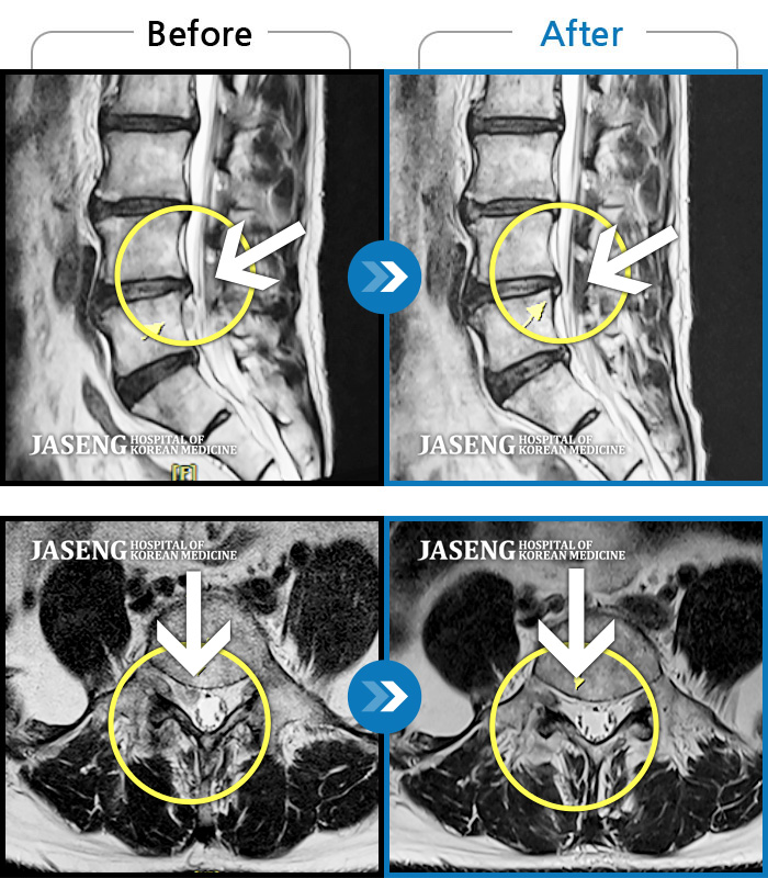 자생한방병원 치료사례 MRI로 보는 치료결과-허리 양측 둔부에서 발가락으로 통증, 비증, 힘이 빠지는 증상