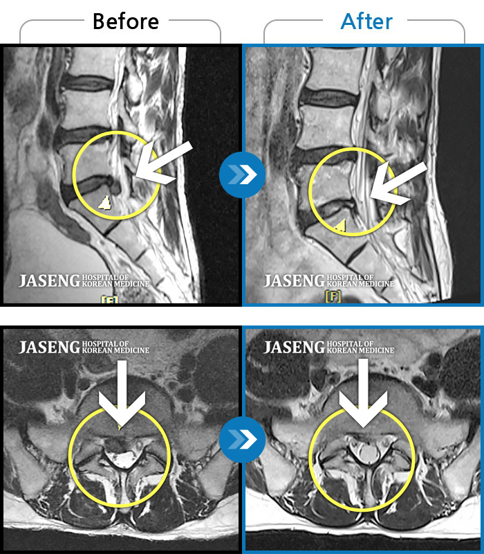 자생한방병원 치료사례 MRI로 보는 치료결과-허리 양측 통증, 서있을 때 찌르는 듯한 증상