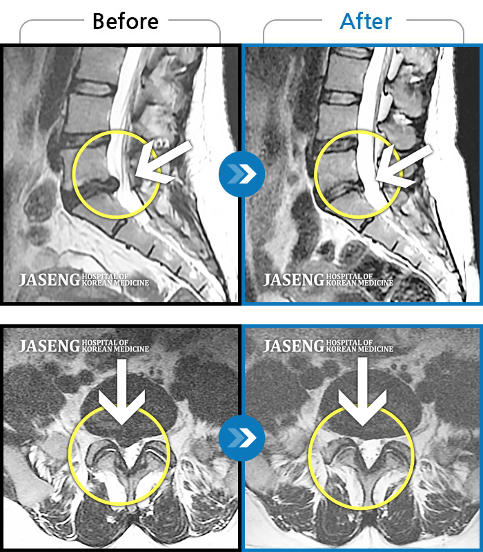 자생한방병원 치료사례 MRI로 보는 치료결과-허리 통증과 오른쪽 다리 당김