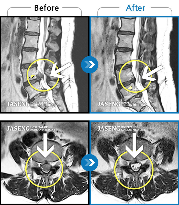 자생한방병원 치료사례 MRI로 보는 치료결과-허리 우측에서 발바닥까지 통증, 누워있을 때 당기는 증상