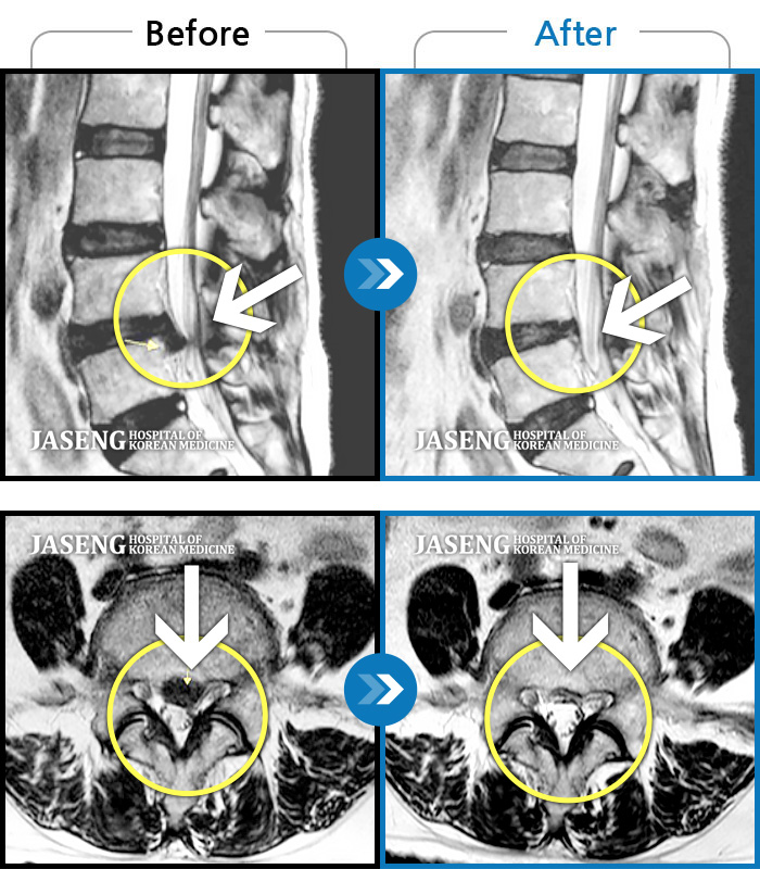 자생한방병원 치료사례 MRI로 보는 치료결과-허리통증, 왼쪽 다리 저림 및 통증