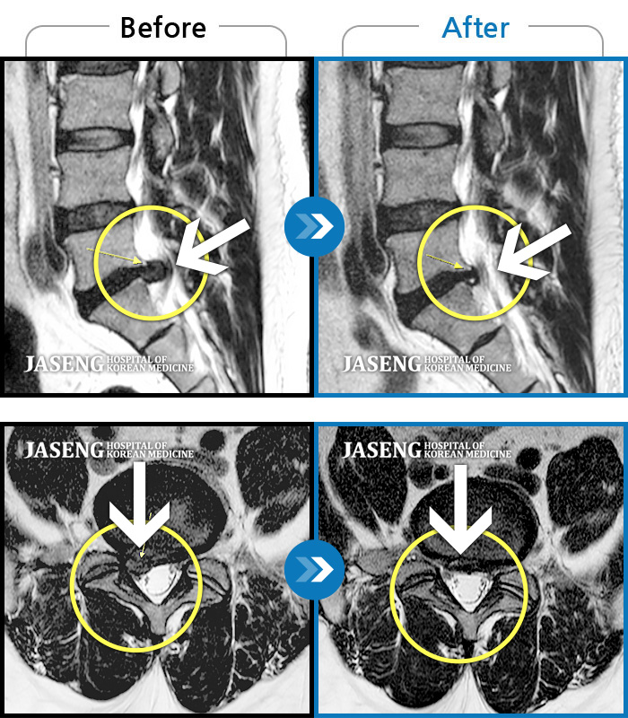 자생한방병원 치료사례 MRI로 보는 치료결과-허리디스크로 인한 방사통