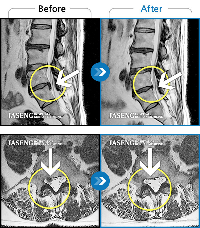 자생한방병원 치료사례 MRI로 보는 치료결과-허리디스크로 우측 발목까지 방사통