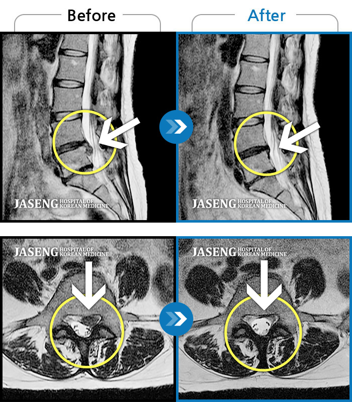 자생한방병원 치료사례 MRI로 보는 치료결과-다리로 내려오면서 발등 부은 증세 나타남