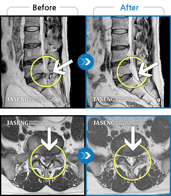 자생한방병원 치료사례 MRI로 보는 치료결과-허리디스크로 다리 감각 둔화 