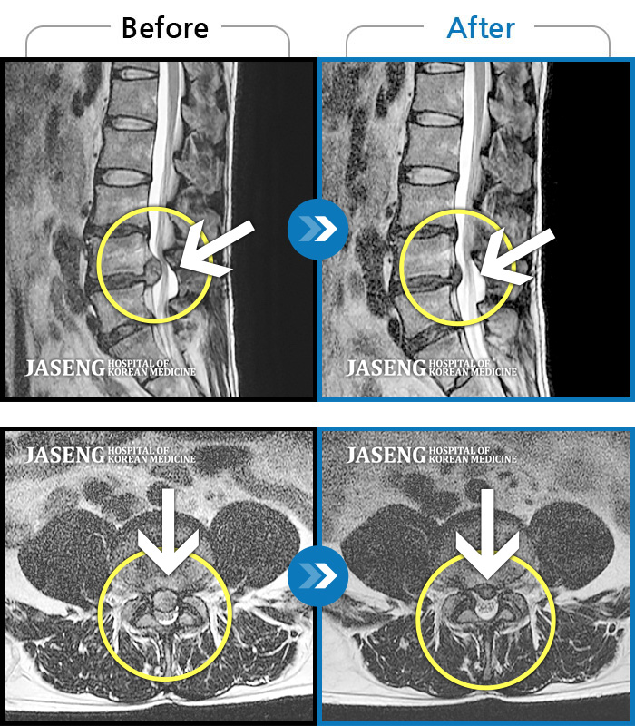자생한방병원 치료사례 MRI로 보는 치료결과-허리부터 꼬리뼈까지 통증, 양쪽 다리 저림 및 통증