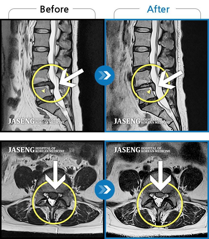 자생한방병원 치료사례 MRI로 보는 치료결과-허리 좌측 골반에서 좌측 발까지 통증