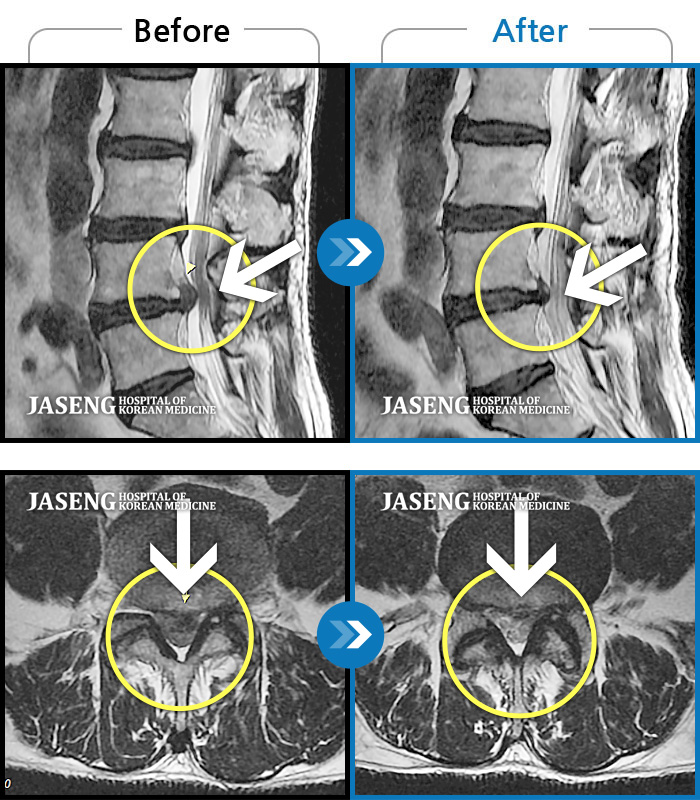 자생한방병원 치료사례 MRI로 보는 치료결과-허리디스크로 옆으로 쪼그려 누워서 내원