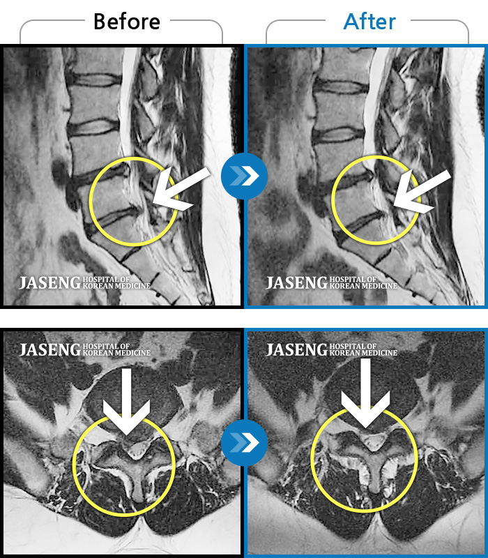 자생한방병원 치료사례 MRI로 보는 치료결과-허리 통증, 우측 종아리 외측으로 당기고 저림