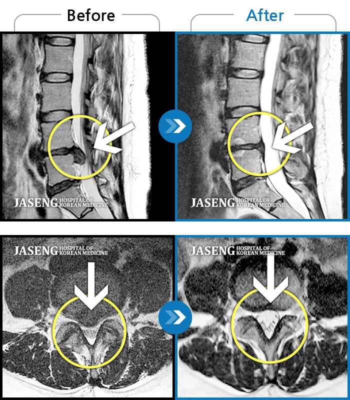 자생한방병원 치료사례 MRI로 보는 치료결과-허리 통증 및 오른쪽 발목의 근력저하