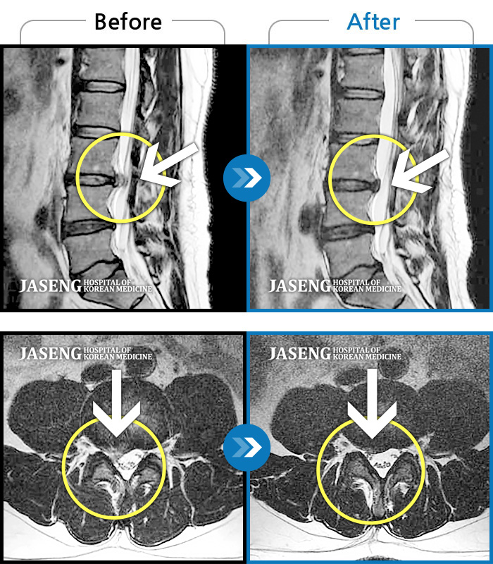 자생한방병원 치료사례 MRI로 보는 치료결과-허리, 우측 엉치, 우측 허벅지 전면, 무릎 통증