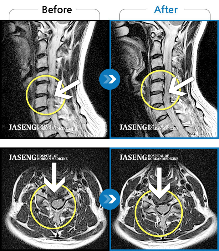 자생한방병원 치료사례 MRI로 보는 치료결과-목을 들면 오른쪽 목 통증과 어깨 통증 발생, 오른쪽 어깨에서 팔꿈치까지 통증