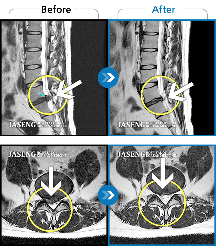 자생한방병원 치료사례 MRI로 보는 치료결과-우측 허리와 다리 저림
