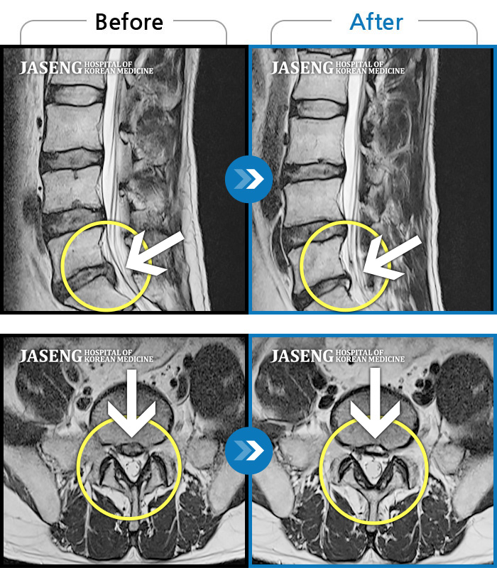 자생한방병원 치료사례 MRI로 보는 치료결과-허리통증과 다리저림
