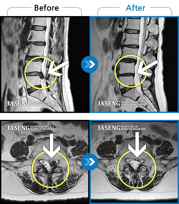 자생한방병원 치료사례 MRI로 보는 치료결과-허리 통증, 야간통으로 내원