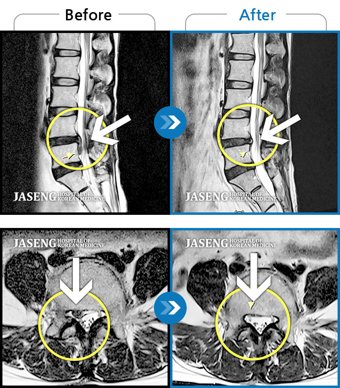 자생한방병원 치료사례 MRI로 보는 치료결과-허리 우측 골반 통증, 우측 다리 저리고 엄지발가락 마비 증상