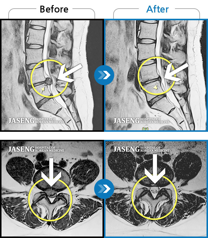 자생한방병원 치료사례 MRI로 보는 치료결과-허리 양측 골반 통증, 서있거나 기침하면 증상 심화