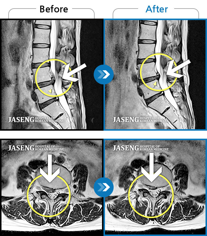 자생한방병원 치료사례 MRI로 보는 치료결과-허리 우측 골반 통증, 2분만 걸어도 힘들고 자세 변경 시 통증 심화