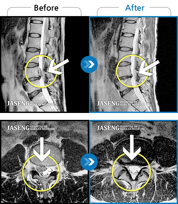 자생한방병원 치료사례 MRI로 보는 치료결과-허리통증 및 우측 하지 방사통