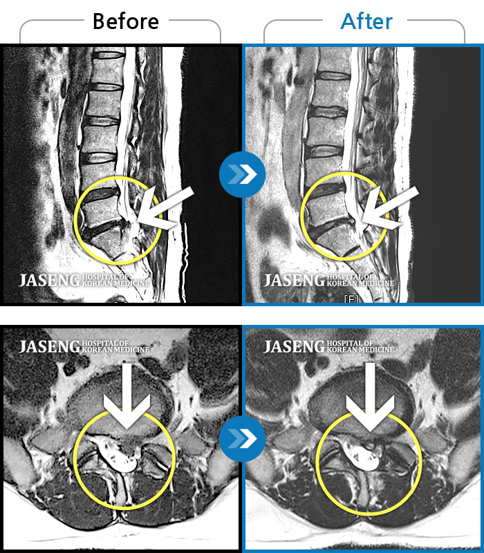 자생한방병원 치료사례 MRI로 보는 치료결과-통증과 좌측 다리 저림이 심해서 거동이 안됨