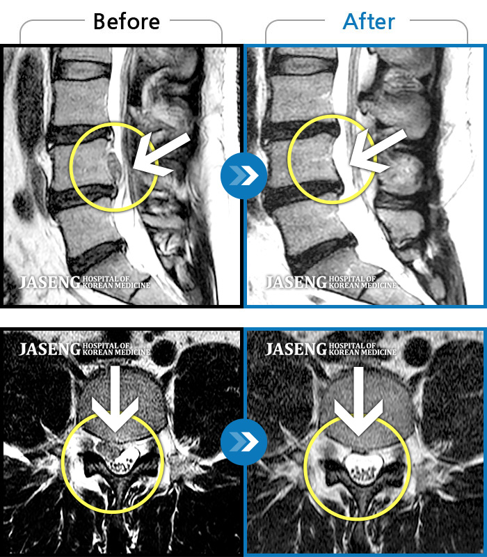 자생한방병원 치료사례 MRI로 보는 치료결과-무거운 철근을 들고나서 허리통증은 심해지고, 우하지의 감각은 무뎌졌습니다.