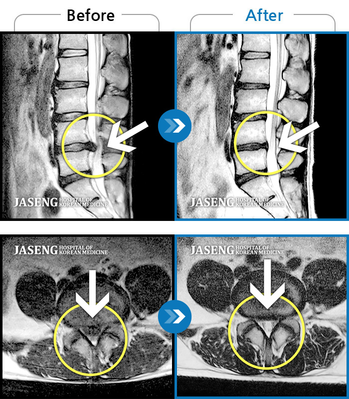 자생한방병원 치료사례 MRI로 보는 치료결과-극심한 요통과 다리 통증으로 허리가 휘어진 채 내원