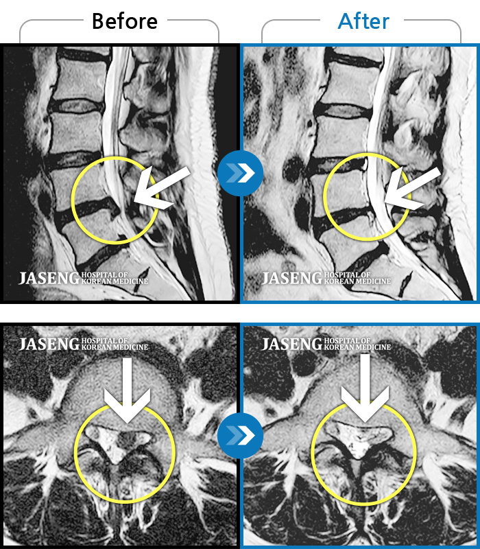 자생한방병원 치료사례 MRI로 보는 치료결과-처음 내원 시 좌측 둔부 하지 바깥쪽의 심한 통증으로 내원하셨습니다. 