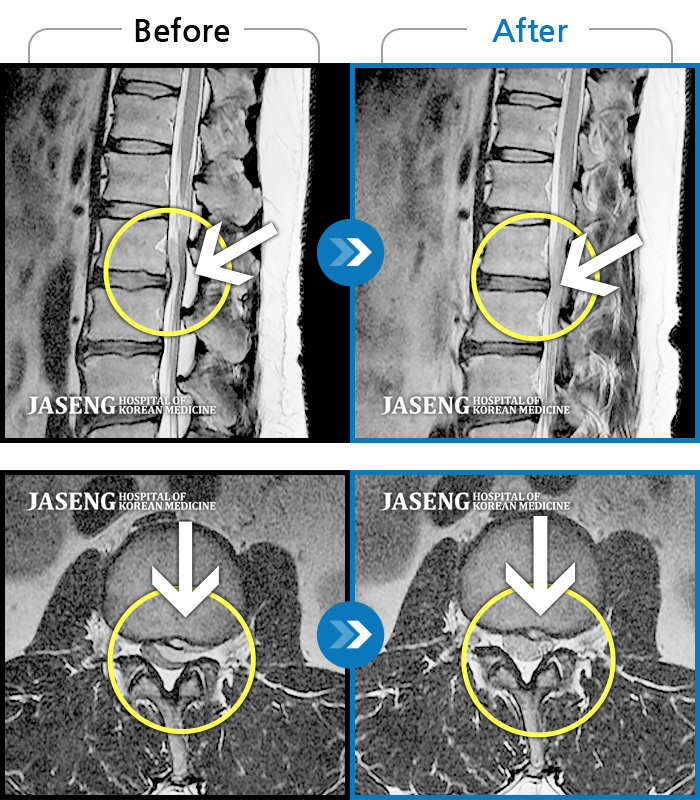 자생한방병원 치료사례 MRI로 보는 치료결과-허리통증 및 우측 하지 방사통, 풋드랍 진행
