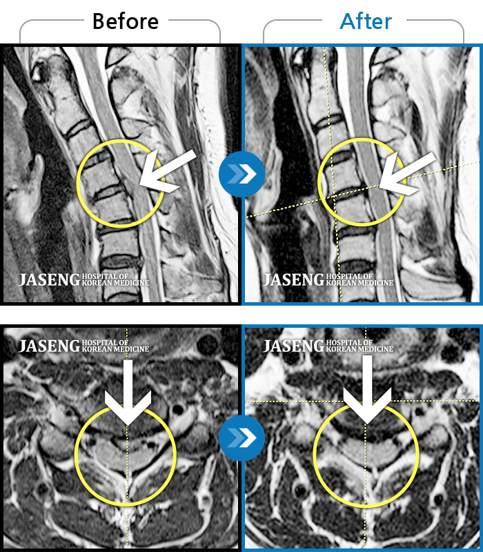 자생한방병원 치료사례 MRI로 보는 치료결과-날개뼈 안쪽의 통증으로 잠을 못 자고 양쪽 손(엄지)의 저림이 심해요.  