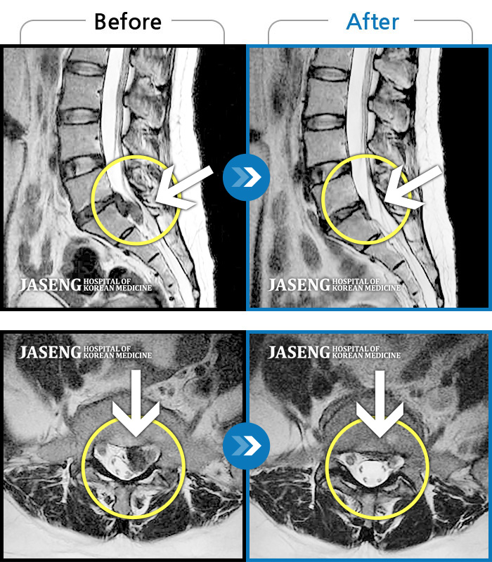 자생한방병원 치료사례 MRI로 보는 치료결과-앉아있을 때 좌측 허벅지가 너무 아프고 야간통도 있다. 허벅지 뒤쪽 감각이 무디고 다리 힘도 빠진다.