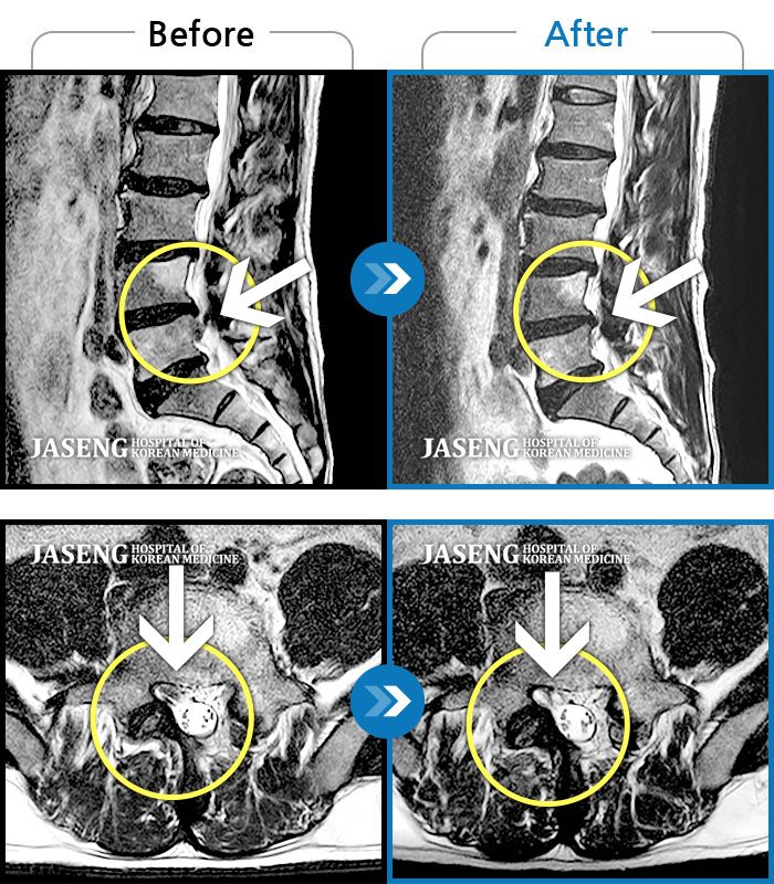 자생한방병원 치료사례 MRI로 보는 치료결과-우측 다리 통증이 심하고 다리 감각이 무뎌요.