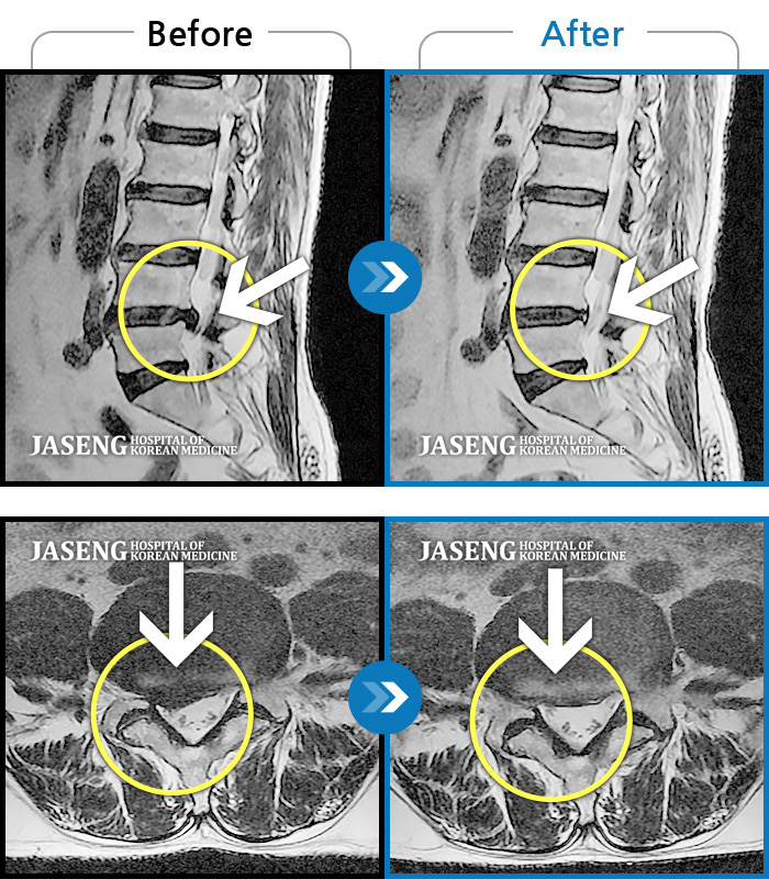 자생한방병원 치료사례 MRI로 보는 치료결과-허리통증이 극심. 우측 종아리쪽이 당기고 저리는 통증으로 자리에 앉지도, 자세를 바꾸지도 못하는 상태