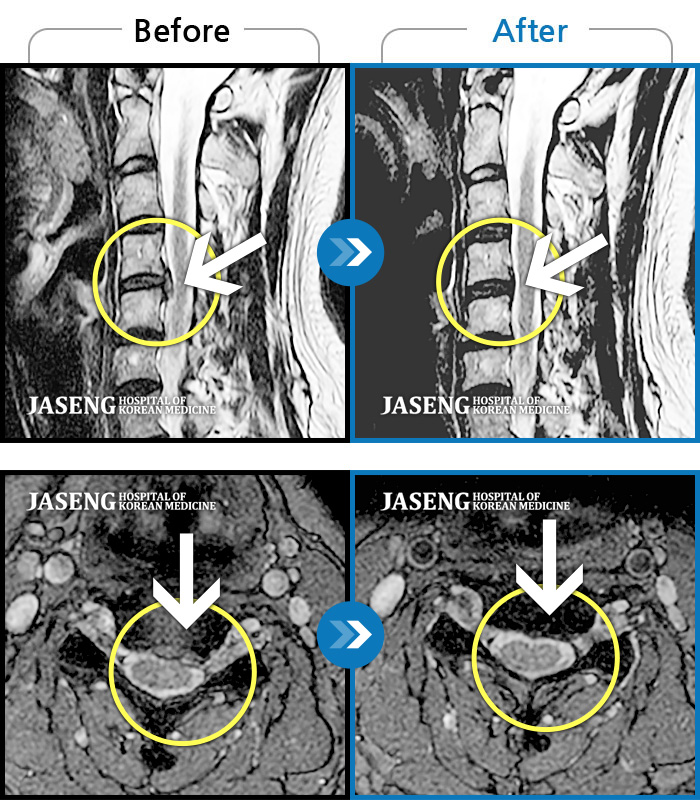 자생한방병원 치료사례 MRI로 보는 치료결과-목, 왼쪽 어깨에서 왼쪽 팔까지 아파요.