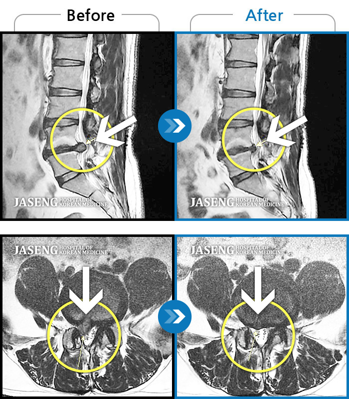 자생한방병원 치료사례 MRI로 보는 치료결과-우측 하요추부 통증-우측 둔부-소퇴 후면 통증/비증