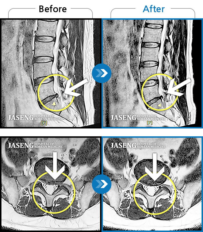 자생한방병원 치료사례 MRI로 보는 치료결과-아침에 일어날 때 심해지는 허리 양측 무거운 통증