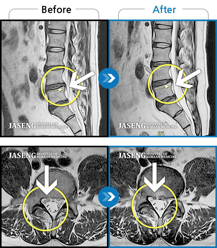 자생한방병원 치료사례 MRI로 보는 치료결과-허리 양측부터 골반까지 통증, 자세 변경 시 증상 심화