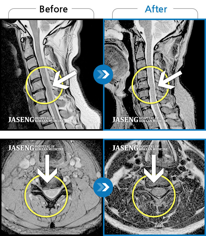 자생한방병원 치료사례 MRI로 보는 치료결과-목을 뒤로 젖힐 때 너무 아프고, 팔이 많이 저려요