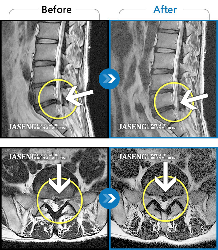 자생한방병원 치료사례 MRI로 보는 치료결과-처음에는 허리만 아프다가 왼쪽 다리가 저리더니 누워있어도 아파져서 자생에서 치료를 받기 시작했어요