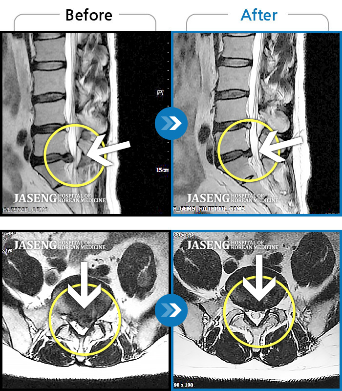자생한방병원 치료사례 MRI로 보는 치료결과-발이 지속적으로 저리고 허벅지 종아리 통증 때문에 허리를 필 수 없었다.