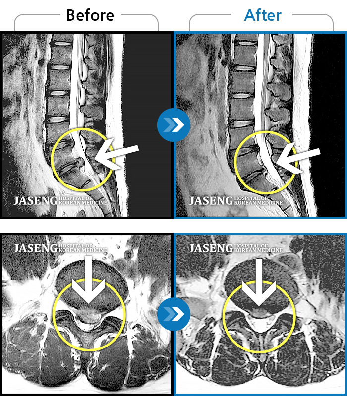 자생한방병원 치료사례 MRI로 보는 치료결과-추간판 탈출증으로 일상생활 힘들었다.