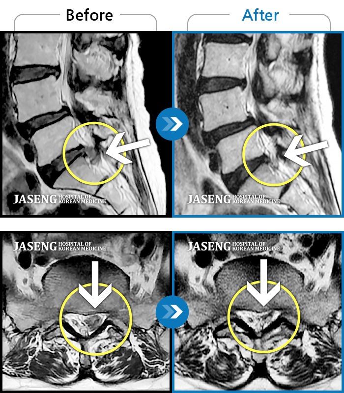 자생한방병원 치료사례 MRI로 보는 치료결과-비수술치료를 위해 내원