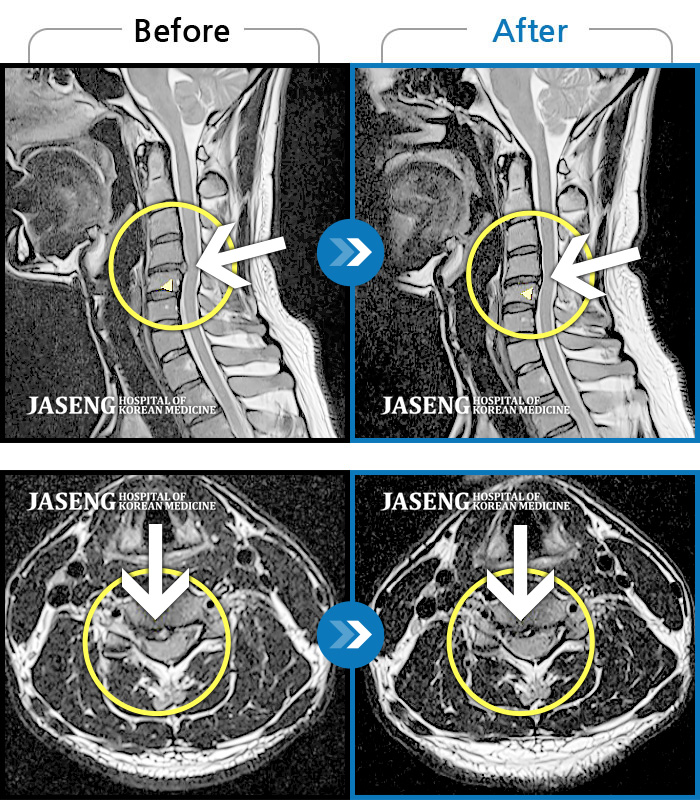 자생한방병원 치료사례 MRI로 보는 치료결과-후경부 양측으로 이어지는 뻐근하고 묵직한 통증 및 야간통
