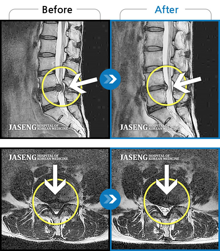 자생한방병원 치료사례 MRI로 보는 치료결과-양쪽 고관절~하지방사통이 심하여 활동하기 힘든 상태