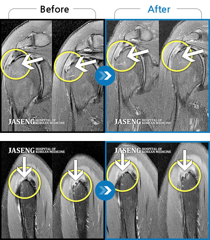 자생한방병원 치료사례 MRI로 보는 치료결과-넘어질때 손을 짚으면서 우측 어깨에 심한 충격이 오고 이후로 심한 어깨 통증으로 일상생활이 힘든 상태로 내원하였습니다.