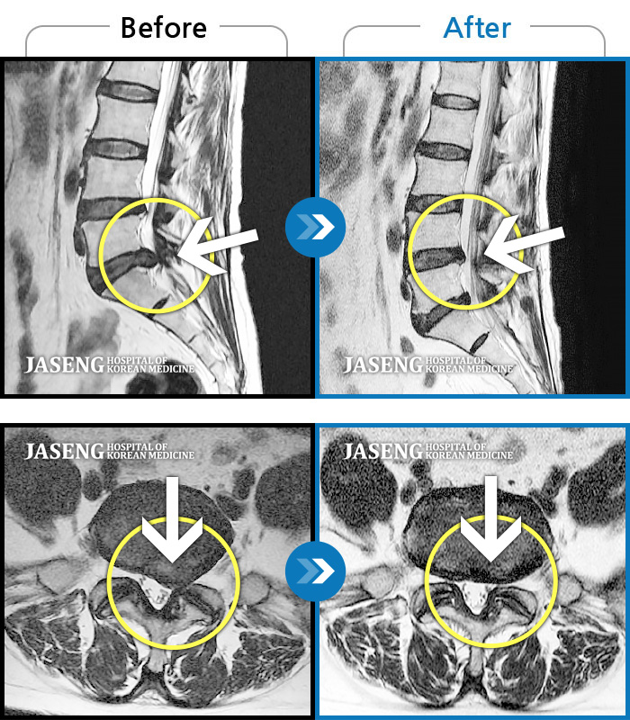 자생한방병원 치료사례 MRI로 보는 치료결과-처음 내원 시 허리와 좌측 다리 통증이 심한 상태로 내원하셨습니다.
