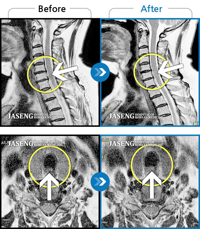 자생한방병원 치료사례 MRI로 보는 치료결과-목 통증과 팔 저림이 심해서 목을 뒤로 젖힐 수가 없어요